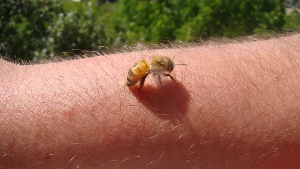 Bee Sting